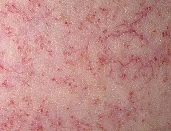 Ataxia-Telangiectasia - Immune Disorders - MSD Manual Consumer Version