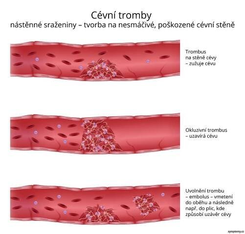 Cévní tromby