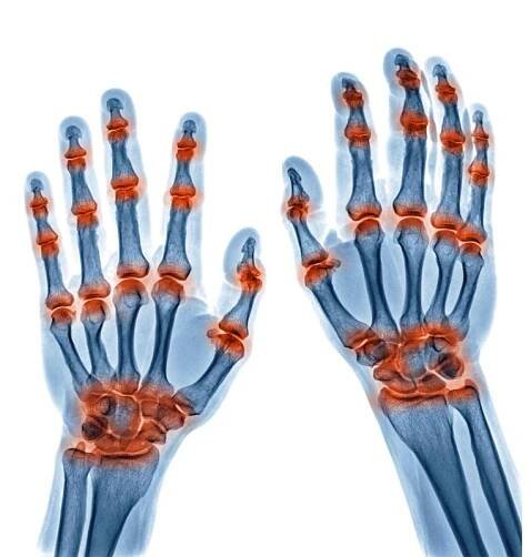 rentgenový snímek víceúrovňového zánětu kloubů v obou rukou způsobených dnavou artritidou, revmatoidní artritidou izolovanou na bílém pozadí - revmatoidní artritida artritidě - stock snímky, obrázky a fotky