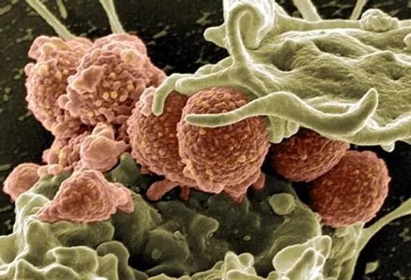 How AI Is Helping Save Lives From Sepsis