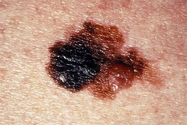 Vyšetření znamének – MUDr. Ivana Holzhauserová – Estetická dermatologie Karlovy Vary