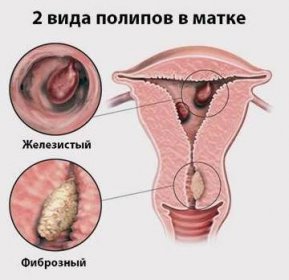 Druhy polypů v děloze