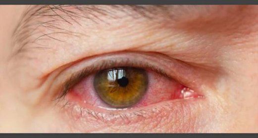 Zánět spojivek může být příznakem koronaviru. Jak oči chránit?  