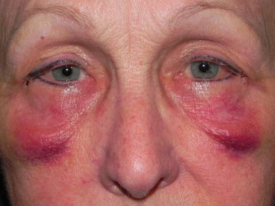 When Eyelid Surgery Isn't Enough – Adam Scheiner MD | Dr. Adam Scheiner