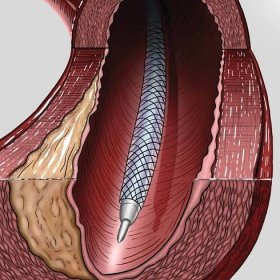 Coronary Artery Disease Percutaneous Coronary Intervention