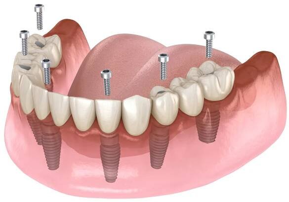 Kdy jsou zubní implantáty vhodné - 3. Náhrada mnoha chybějících zubů