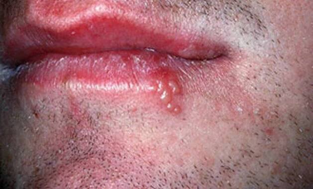cold sore massage