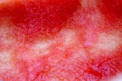 Polovina červeného melounu byla snědená — Stock obrázek