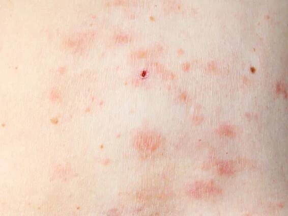 Kožní vyrážka léčba na těle ženy. pásový opar, choroba, herpes zoster, virus varicella-zoster. kožní vyrážka a puchýře na těle — Stock obrázek
