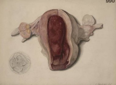 Polyp děložní sliznice – WikiSkripta