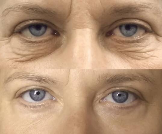 Operace očních víček – foto před a po | Perfect Clinic