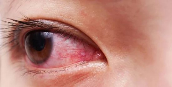 Neléčené alergie mohou vést k vážným zdravotním potížím