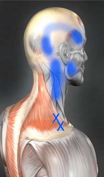 CEFALEAS Y SU RELACIÓN CON LA MUSCULATURA DEL CUELLO Y CABEZA - Nacho Varela