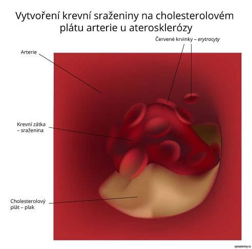 Ateroskleróza - příznaky a léčba