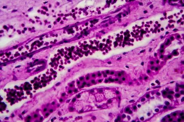 Systemic Vasculitis - Sayaa Med