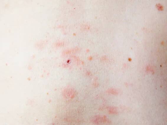 Kožní vyrážka léčba na těle ženy. pásový opar, choroba, herpes zoster, virus varicella-zoster. kožní vyrážka a puchýře na těle — Stock obrázek