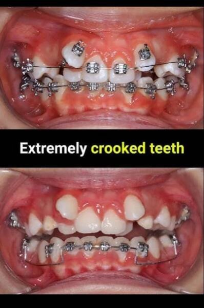 Braces evolution crooked teeth #braces #orthodontist #dentist #brackets