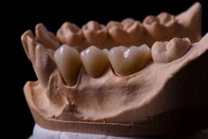 Plíseň zubů. Sádrovec model sádry zubů. Stomatologické sádrové odlitky, formy lidských čelistí a zubů na černém pozadí. Zubní a ortodontický koncept. — Stock obrázek