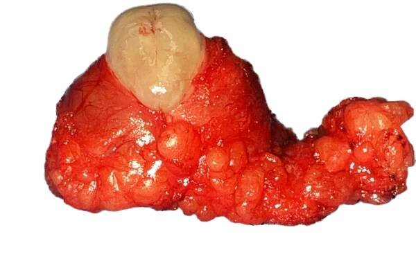 Thyroglossal duct cysts