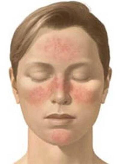 Rosacea na příčkách a léčbě / Rosacea | Užitečné informace a tipy na péči o sebe. Zdraví, výživa a další.