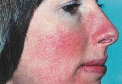 Zčervenání nosu může být příznakem erysipela / Články