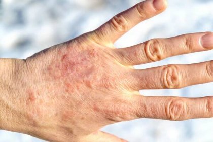 Nová léčba atopické dermatitidy přináší úlevu do pár dní - Hledám zdraví