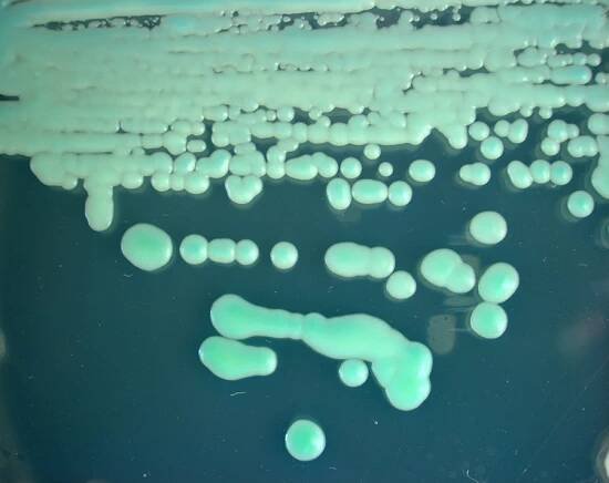 Cystic Fibrosis_CF