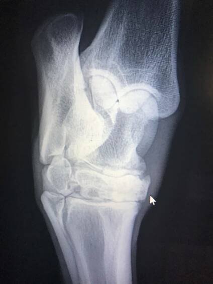 Fused distal inter-tarsal joint