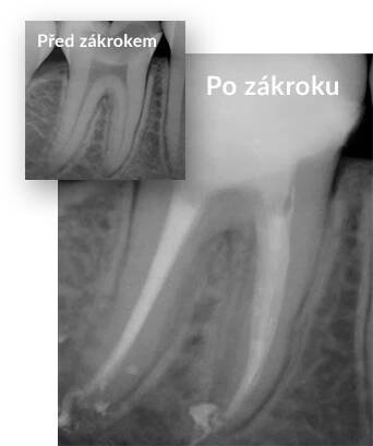 Fotka s případovou studií před-po. Na první force je vidět zub s nezaplněným kořenovýcm systémem a na druhé je vidět zub s dokonale zaplněným kořenovým systémem.