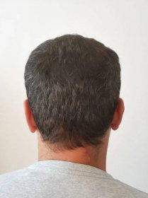 Результат после пересадки волос