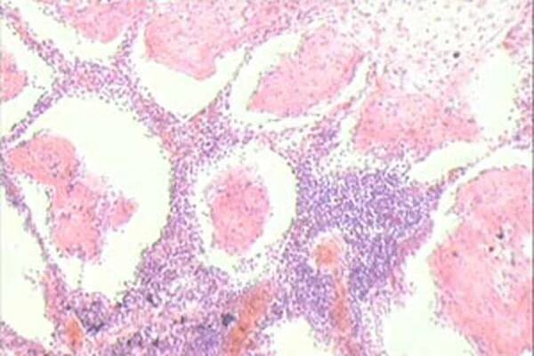 Plicní absces, co to je a jak se léčit? / Absces | Užitečné informace a tipy na péči o sebe. Zdraví, výživa a další.