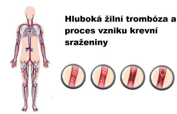 Obrázek z anatomie člověka zobrazující cévní systém a čtyři malé obrázky znázorňující fáze tvorby krevní sraženiny