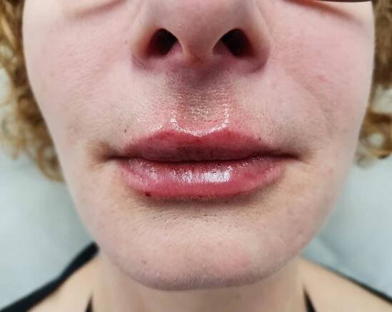 1 ml Filler (Saypha), foceno ihned po zákroku