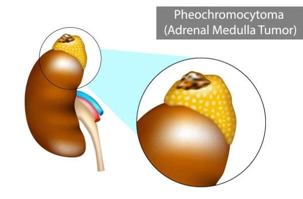 feochromocytom (ph nebo pcc). - nadledvinka stock ilustrace