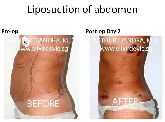 Liposuction Case Studies by Dr Arthur Tjandra of L’Élixir de Vie