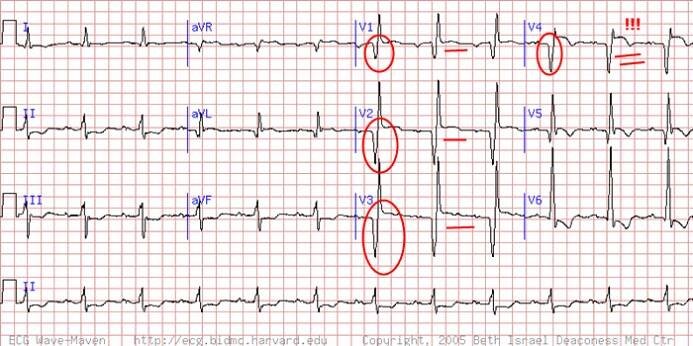 Jizva myokardu - EKG | Medicína, nemoci, studium na 1. LF UK