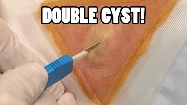 Smash's Pearl White Double Cyst Removal with Dr. Gilmore