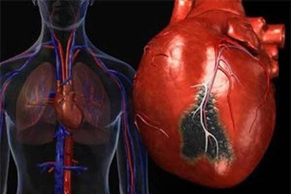 Rozsáhlý infarkt srdce / Infarkt myokardu