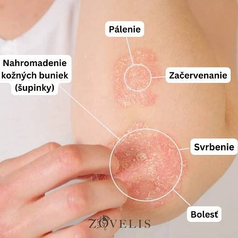 PSORIÁZA na pokožke hlavy - Zovelis Hair Clinic