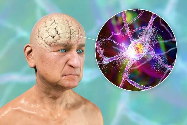 Alzheimer’s may not be a brain disorder, important data was fabricated