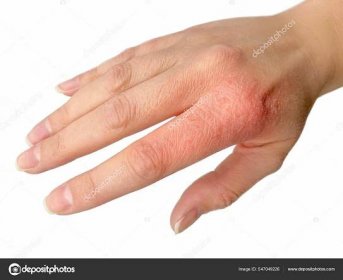 Ekzém na ruce zblízka. Dermatitida nebo suchá kůže z antiseptik.