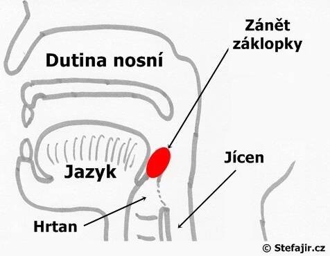 Epiglotitida | Medicína, nemoci, studium na 1. LF UK