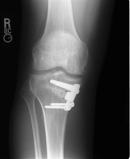 High tibial osteotomy at Kochi, Kerala, India