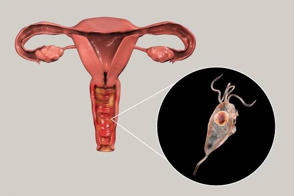 Žena trichomoniáza, 3D ilustrace ukazující vaginitidu a detailní pohled na parazita Trichomonas vaginalis — Stock obrázek