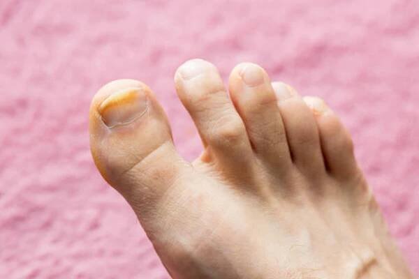 onychomykóza, počáteční fáze kožního onemocnění. velký toe infikovaný plísňovými bakteriemi, pozadí pacifická růžová - bad pedicure - stock snímky, obrázky a fotky