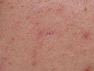 Akné na kůži obličeje, dermatologické onemocnění akné — Stock obrázek