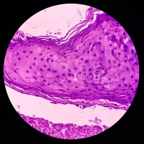 karcinom ústní sliznice: spinocelulární karcinom, špatně diferencovaný, vykazují fibrokolagenní tkáň, maligní novotvar - skvamocelulární karcinom - stock snímky, obrázky a fotky