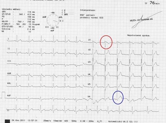 Blokáda pravého raménka Tawarova - EKG | Medicína, nemoci, studium na 1. LF UK