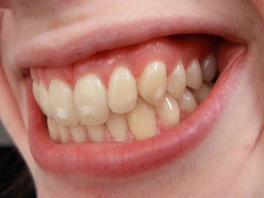 Soubor:Dental fluorosis.jpg – WikiSkripta