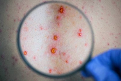 neštovice - kontaktní dermatitida - stock snímky, obrázky a fotky